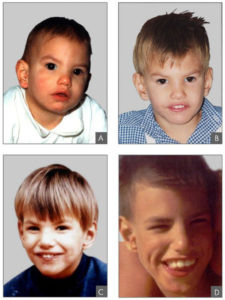 Collage of children with physical characteristics of Cri-Du-Chat Syndrome