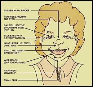 A visual representation of the characteristics related to Williams Syndrome